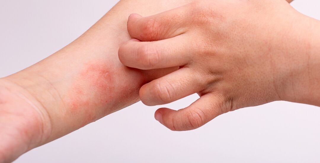eczema causes and treatment